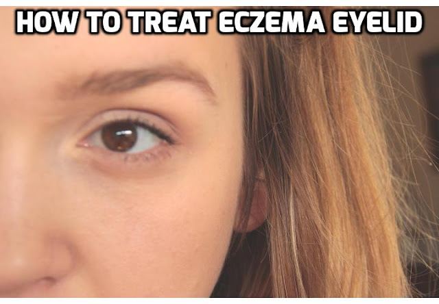 People who are looking for ways to treat eczema on eyelid usually suffer from swollen, wrinkled, itching or burning eyelids. And given the fact that it is near the eye area, extra care should be taken to avoid complications. Read on to find out more.
