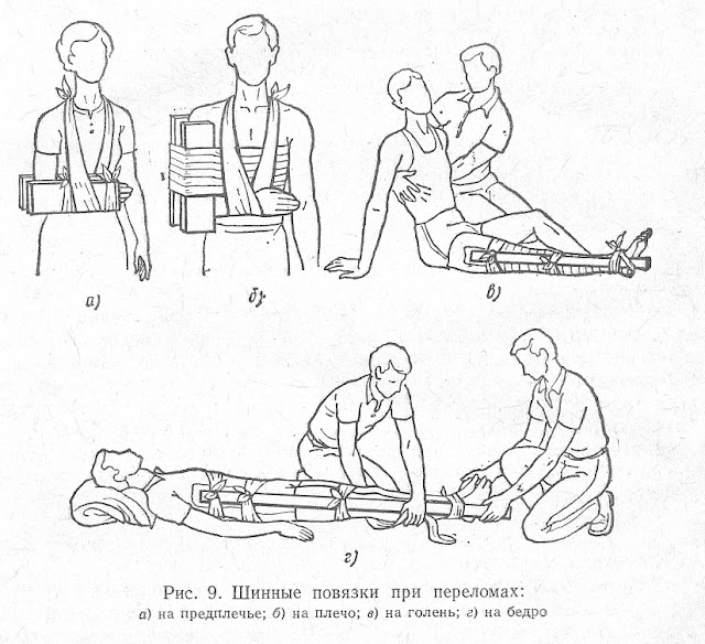 Шинные повязки при переломах