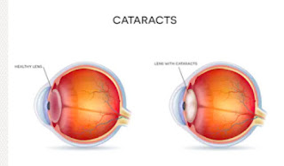 cataract surgery in Singapore