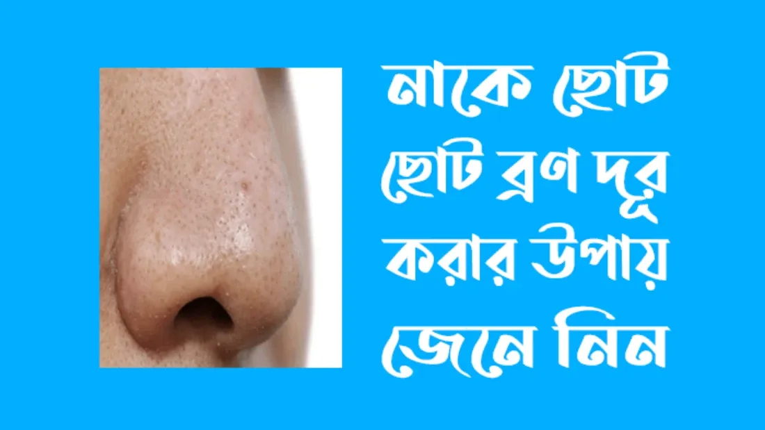 নাকে ছোট ছোট ব্রণ দূর করার উপায়