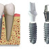 Implant khắc phục móm do mất răng