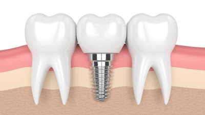 Quy trình cấy ghép implant răng cửa chuẩn nhất-2