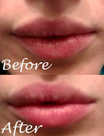 lips_before_after