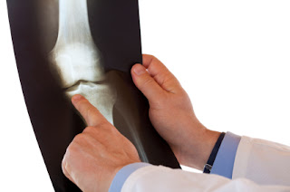 Orthopedic Treatment India