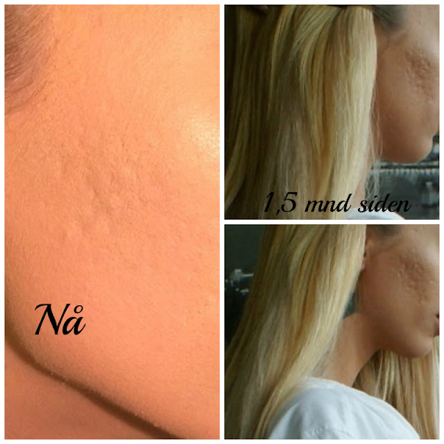 Les photos du traitement CIT Face Roller (avant / après )