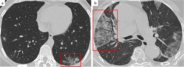 Gambar 2 : a. Seorang pasien COVID-19 wanita berusia 34 tahun yang mengalami demam dengan batuk kering selama 2 hari. CT scan menunjukkan sedikit pola retikuler di lobus kiri bawah dan area subpleural (kotak merah). b. Seorang pasien COVID-19 wanita 81 tahun yang mengalami demam disertai batuk selama 7 hari. CT scan menunjukkan pola retikuler dibalik GGO, menyerupai tanda pola batu paving yang tidak beraturan di lobus tengah kanan (kotak merah).