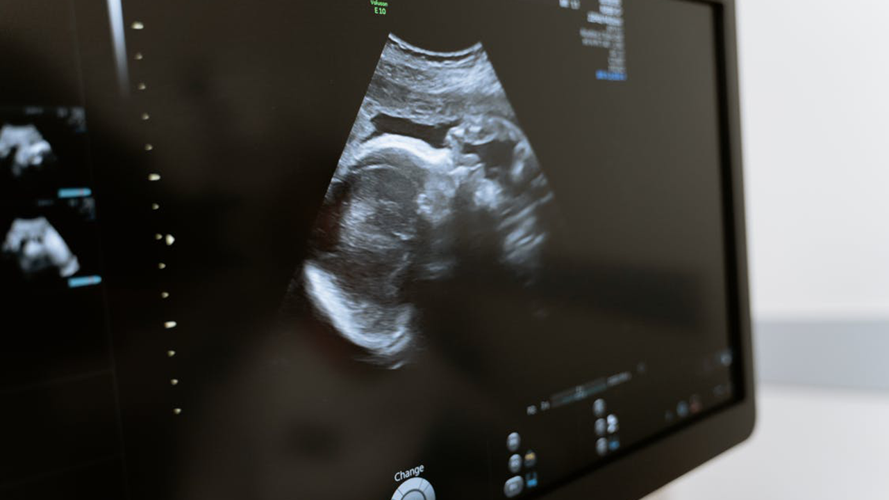 Kantung Kehamilan Berisi Janin dan Terlihat di USG