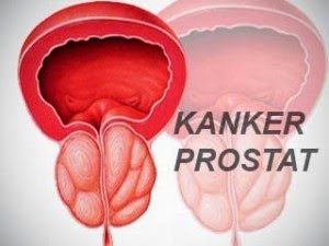 pengobatan kanker Prostat tradisional, kanker prostat, obat kanker prostat