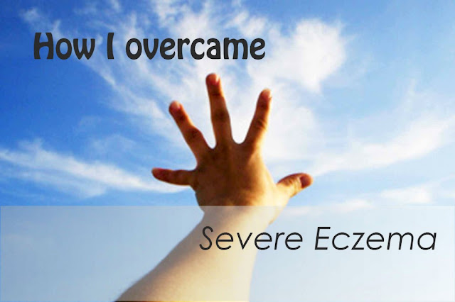 Are you on the lookout for some ways to treat severe eczema? Check out this solid eczema treatment program, to restore your skin’s texture and health.