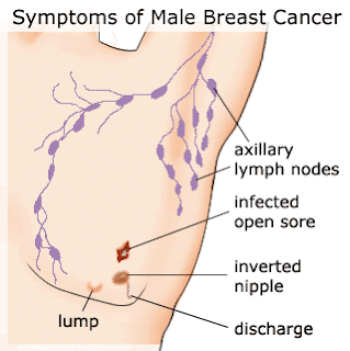 12 Myths to Ignore About Breast Cancer