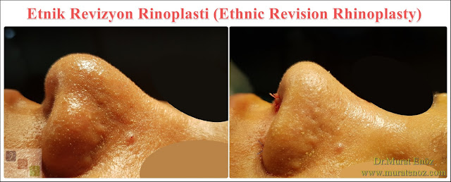 Ethnic Revision Rhinoplasty Istanbul - Ethnic Revision Nose job in Istanbul – Ethnic Revision Nose Surgery in Istanbul – Ethnic Revision Nose job in Turkey - Ethnic Revision Turkey - Ethnic Revision in Turkey - Revision African American rhinoplasty - Ethnic expert nose job surgeon - Rhinoplasty Surgeon in Istanbul - Black Nose Job - Revision Rhinoplasty For Ethnic Nose - Revision Rhinoplasty For African People - African American Nose Surgery – Rhinoplasty for African American Nose - Thick Skin Rhinoplasty - Rhinoplasty in istanbul