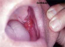 <img src="carcinoma-carrillo y-pilar anterior.jpg" alt="Ulceración maligna que involucra carrillo y faringe">