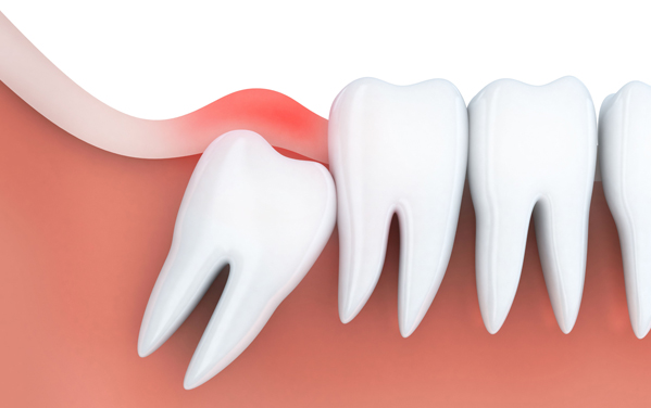 Misaligned wisdom tooth