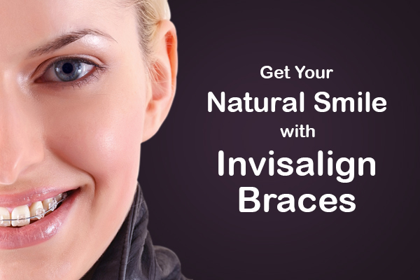 Invisalign Braces for Natural Smile