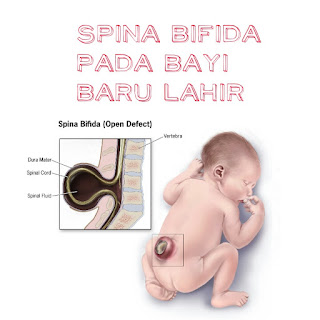 spina bifida