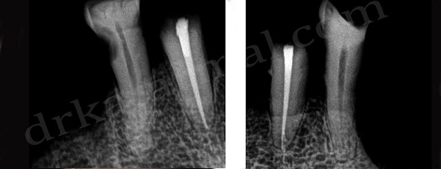 Root canal Treatment done in both lower canines