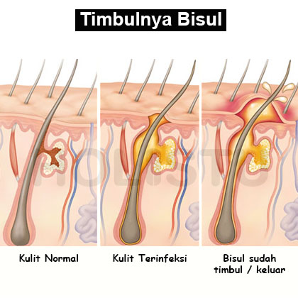 Gambar yang menunjukkan Penyebab Timbulnya Bisul