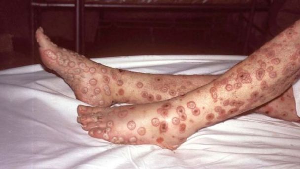“Profeta do mal”: Após Bill Gates prever uma possível pandemia de varíola, vários países começam registrar vários casos