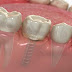 Chi phí trồng răng implant giá bao nhiêu?
