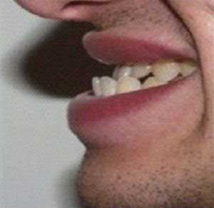 Cách khắc phục răng móm triệt để nhất từ các chuyên gia nha khoa