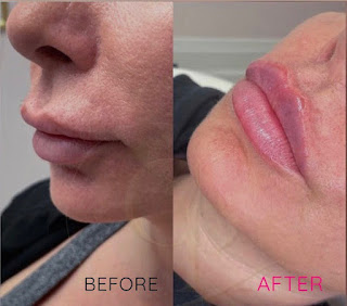 Belkyra chin treatment