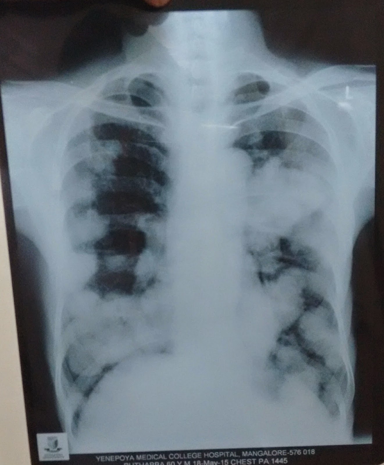 Signs in chest imaging | PDF
