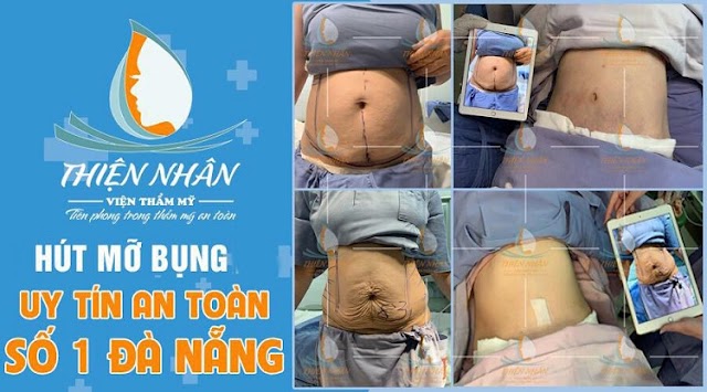 Hé lộ: Địa chỉ hút mỡ bụng ở đâu an toàn tại Đà Nẵng