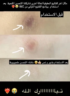 مقشر احماض الفواكه من الصيدلية