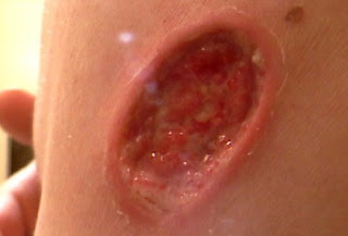 skin cancer pic