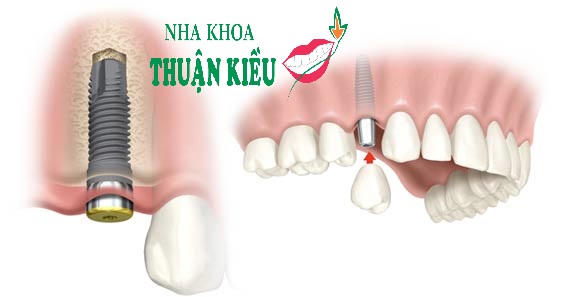 dental-implants-surgery-care