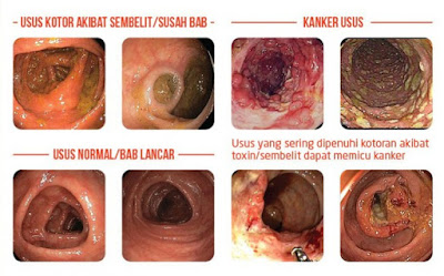 Ubat Kurus  Paling Berkesan,Halal,Lulus KKM,Murah,Selamat 