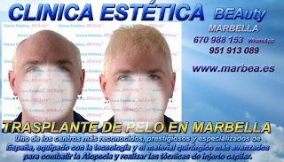 implante PELO MARBELLA Clínica Estética  {implante|injertos|trasplante} {pelo|capilar|cabello} {para mujeres |mujeres } {o|or|y} {para hombres|hombres} {o|or|y} {en Marbella|Marbella} y {en Málaga|Málaga}: Te {ofrecemos|proponemos} la {mayor|alta} calidad de {servicios|nuestroservicio} con los mejores 