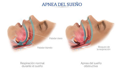 Apnea obstructiva del sueño