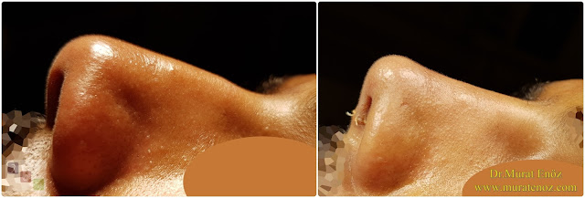 Nasal root filling with subcutaneous tissue - Nasal root filling with underskin tissue - Nose tip plasty - Limited nasal hump removal - Limited nasal hump reduction - Rhinoplasty without breaking the bone - Nose tip plasty in men Istanbul - Nose tip surgery in Istanbul - Nose tip plasty in Turkey