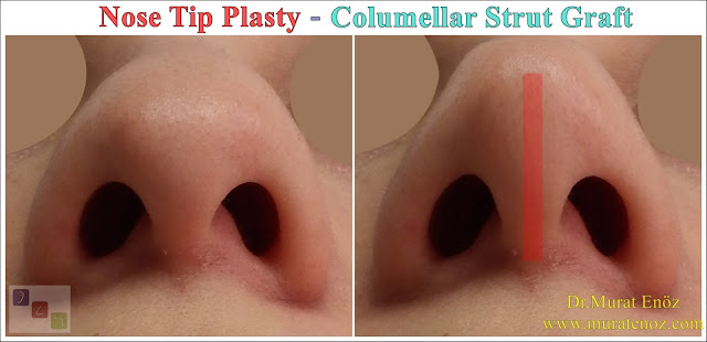 Nose tip stiffness after nasal tip surgery - Why nose tip become harden after nose tip plasty? - Nose tip sagging - Droopy nose tip- Nose tip sag when smiling - Nose tip drop - What is the columellar strut graft? - How does columellar strut grafts work? - How is the columellar strut graft placed? - Nose tip aesthetics - Nose tip lifting