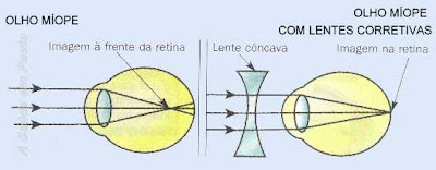 Esquema da formação da imagem em um olho míope. A imagem se forma antes da retina. É necessário uma lente divergente para corrigir o problema.