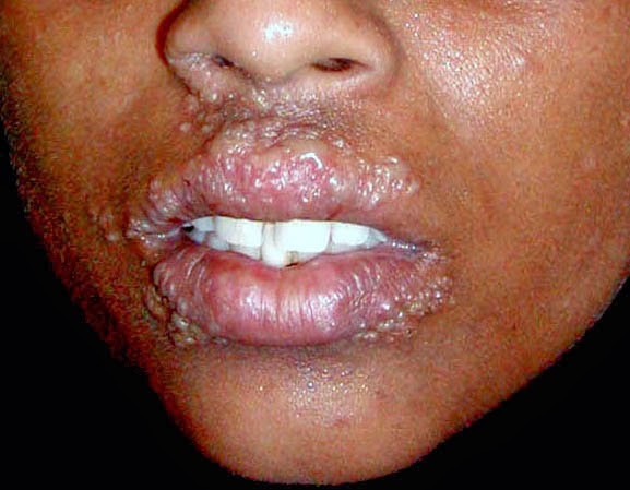 cara menghilangkan herpes