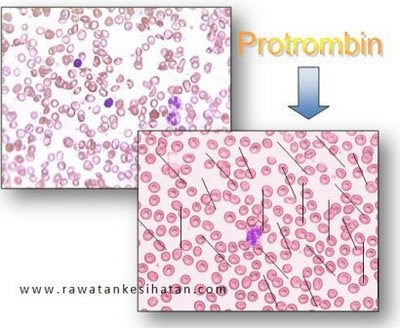Protrombin bertindak membantu pembekuan darah