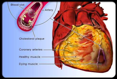 heart attack diagram. heart attack diagram. disease