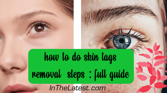 Wondering about skin tags removal ? We talked to expert dermatologists about safe skin tag elimination. Read on to find out how to get rid of skin tags