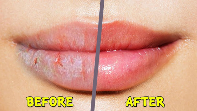 Top 7 remèdes maison pour réparer la peau des lèvres