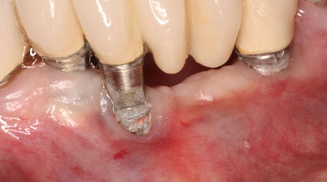 trồng răng implant bị hư nặng