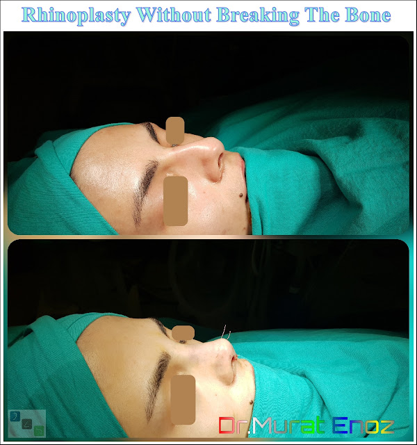 Rhinoplasty Operation Without Breaking The Nasal Bone