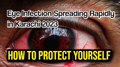 Eye Infection Spreading Rapidly in Karachi, Pakistan-Eye Infection on the Rise in Karachi: How to Protect Yourself