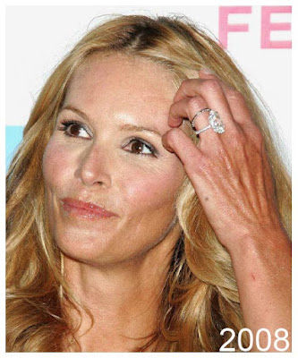 Elle Macpherson Plastic Surgery