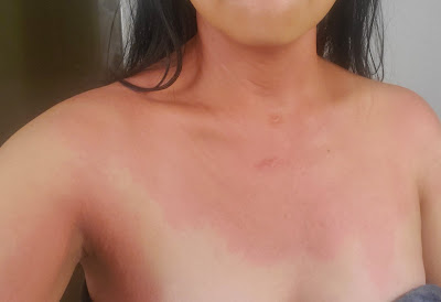 Allergic reaction to cold, red skin, itchy red skin