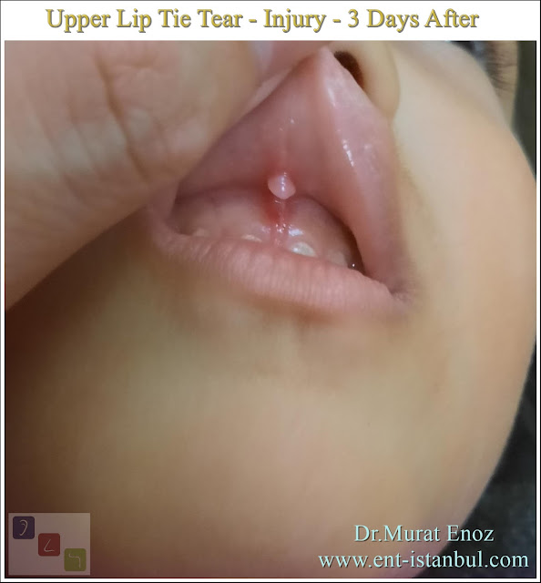 Liabial Frenulum Tear,Upper Lip Tie Injury,