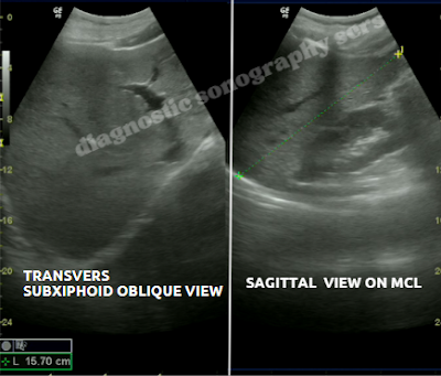 Liver Ultrasound Indications