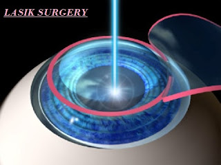 Lasik Surgeon