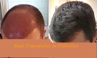 hair transplant in Islamabad